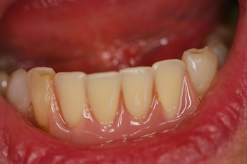 Dentures